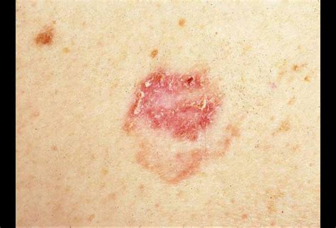 history of non melanoma skin cancer icd 10